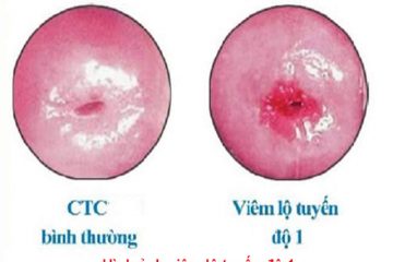 Viêm lộ tuyến cổ tử cung độ 1, Giải pháp Hyalosan hỗ trợ điều trị hiệu quả viêm phụ khoa từ Châu Âu