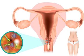 Nguy cơ viêm âm đạo do vi khuẩn và cách phòng tránh